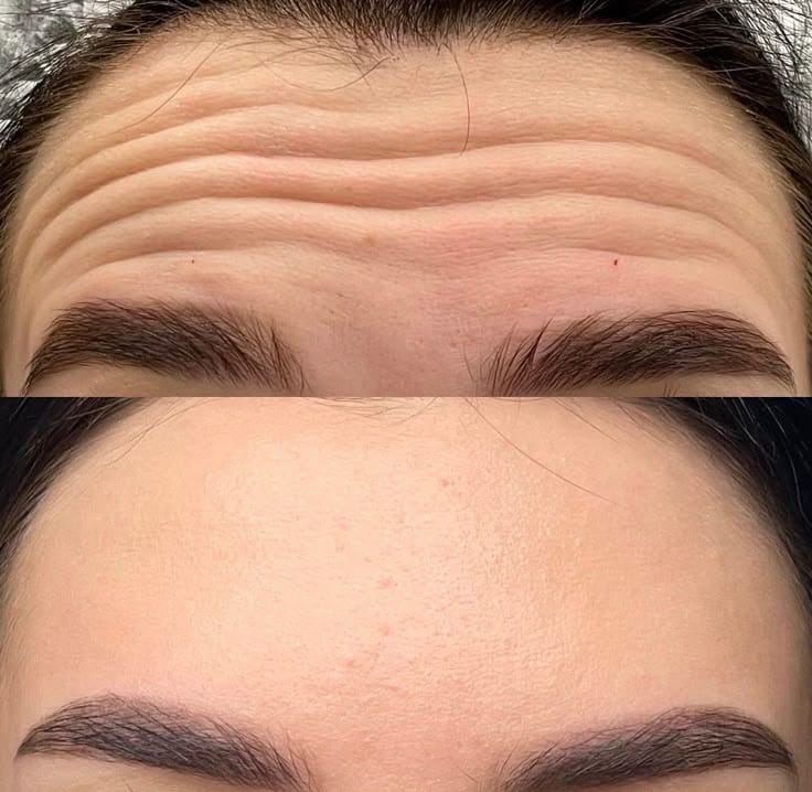 Θεραπεία Botox