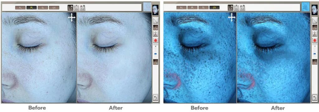 Skin Analysis System της Medi-Nova – αποτέλεσμα