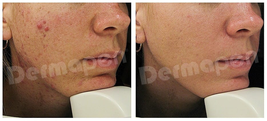 DERMAPEN 4 – αποτέλεσμα