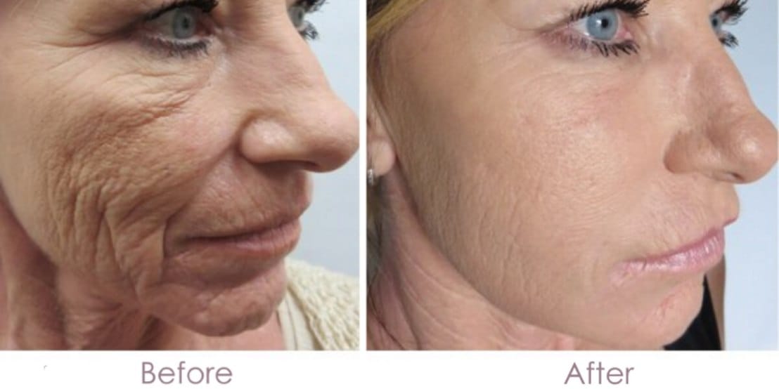 DERMAPEN 4