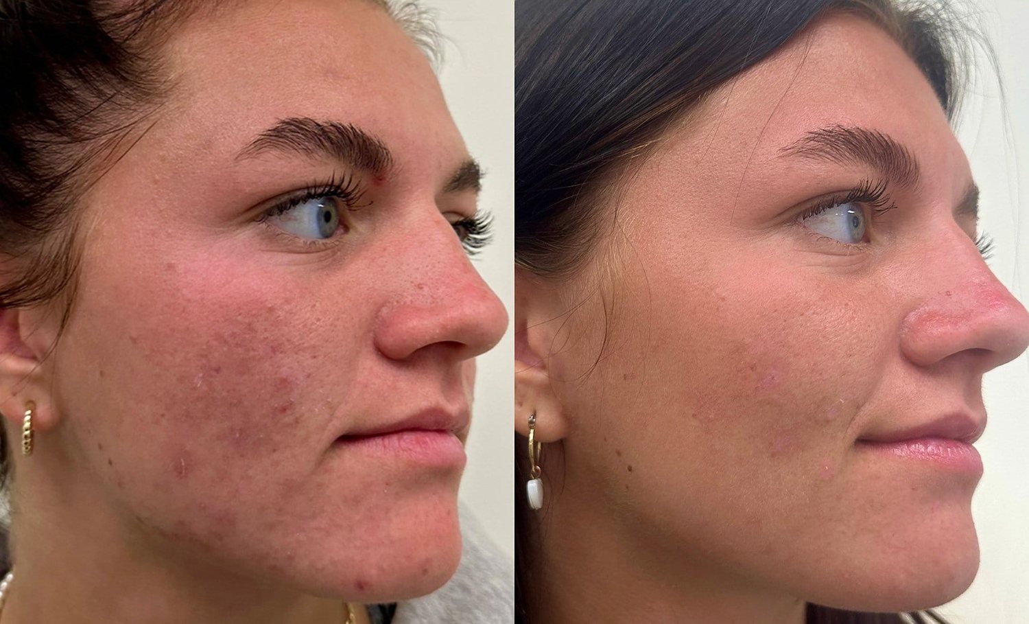 DERMAPEN 4