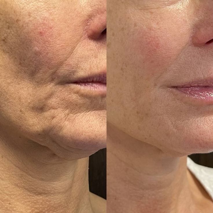 Skin Boosters