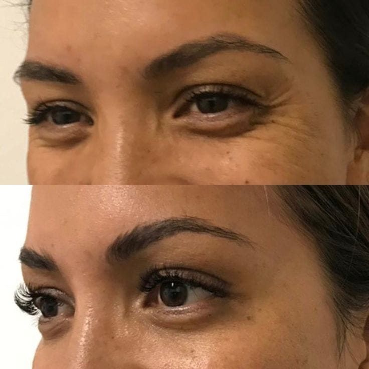 Skin Boosters – αποτέλεσμα